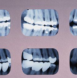 Teeth xrays — periodontal treatment in Springfield, PA Teeth xrays — periodontal treatment in Springfield, PA