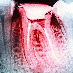 Decayed teeth — tooth care in Springfield, PA Decayed teeth — tooth care in Springfield, PA