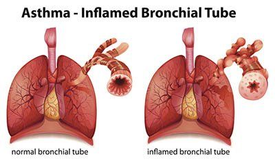 Bronchial Tube Chart - Asthma Treatment in Tampa, FL Bronchial Tube Chart - Asthma Treatment in Tampa, FL