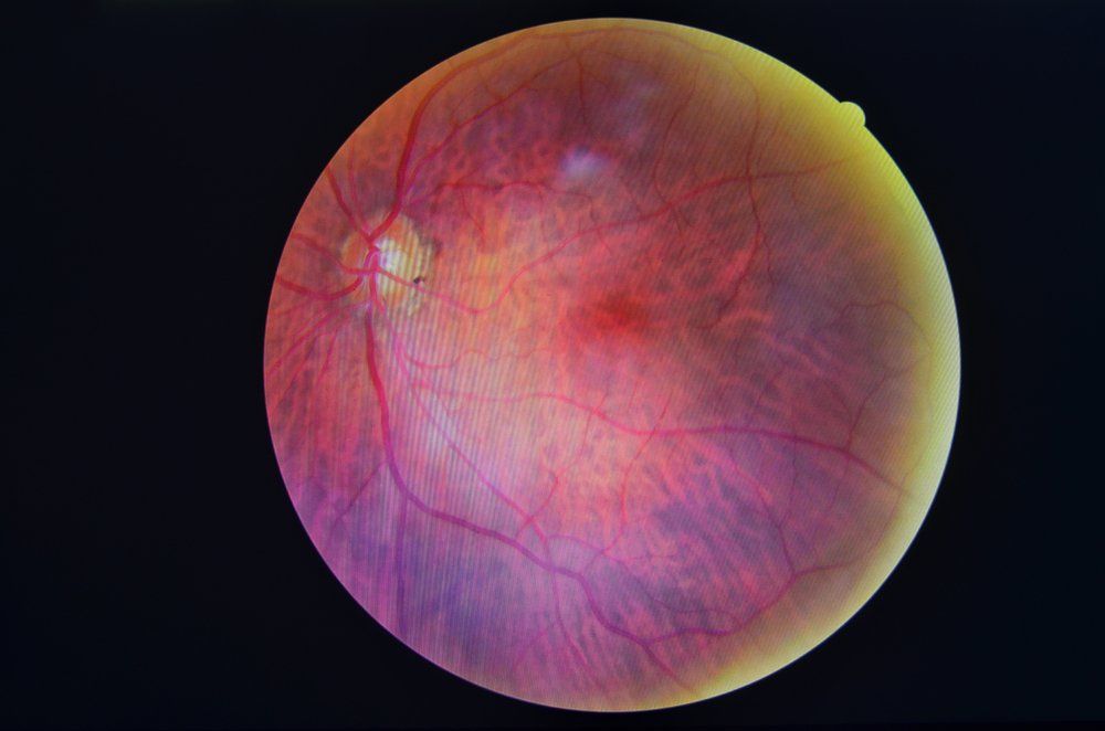 DIABETIC RETINOPATHY