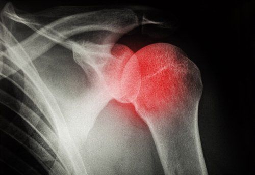 X-ray of a shoulder joint, highlighted with red indicating inflammation or injury.