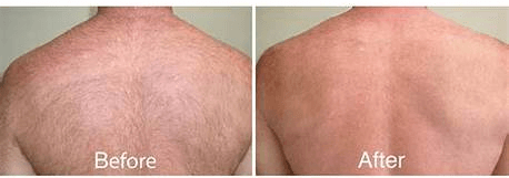 A before and after picture of a man 's back.
