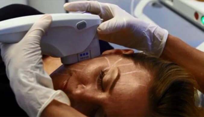 A woman is getting an ultrasound treatment on her face