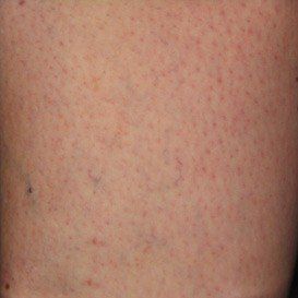 A close up of a person 's skin with a lot of red spots.