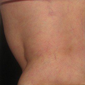 A close up of a person 's back with red veins.