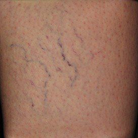 A close up of a person 's leg with varicose veins.