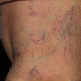 A close up of a person 's back with spider veins.