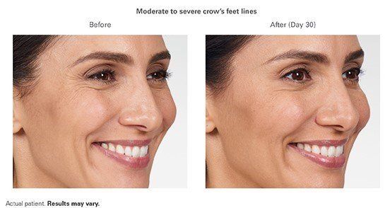 A before and after photo of a woman 's face.