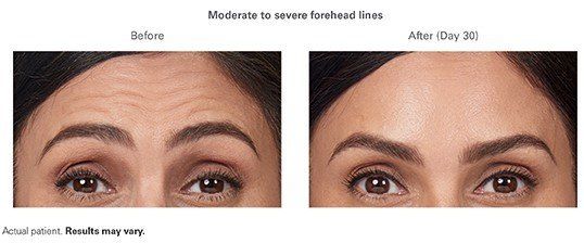 A before and after picture of a woman 's forehead.