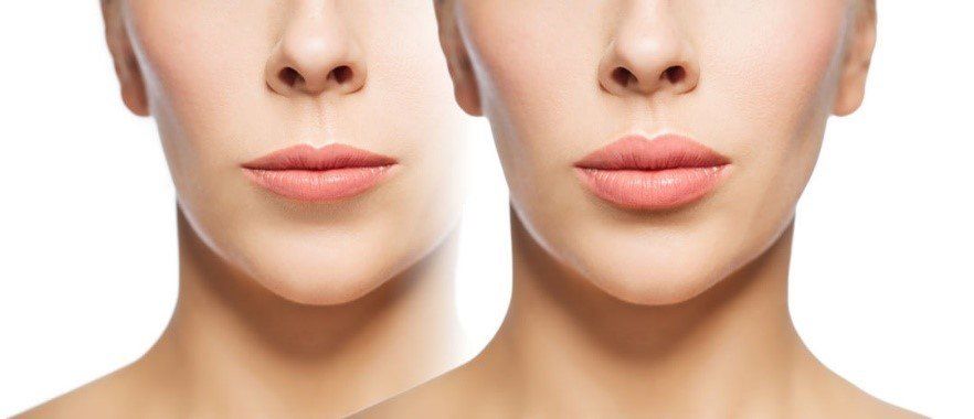 A before and after photo of a woman 's lips.