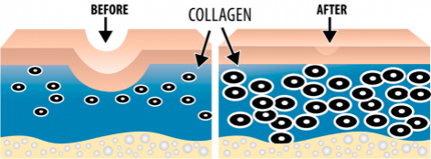 A before and after picture of collagen in the skin