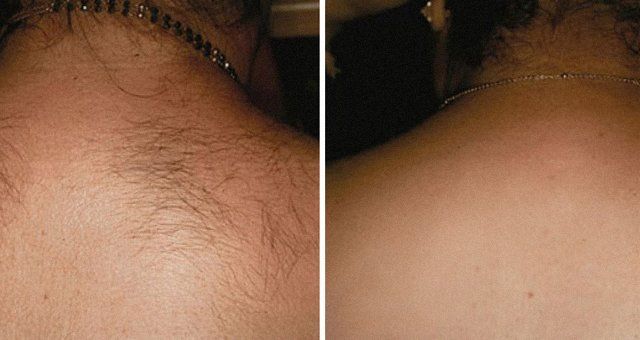 hair removal client's back