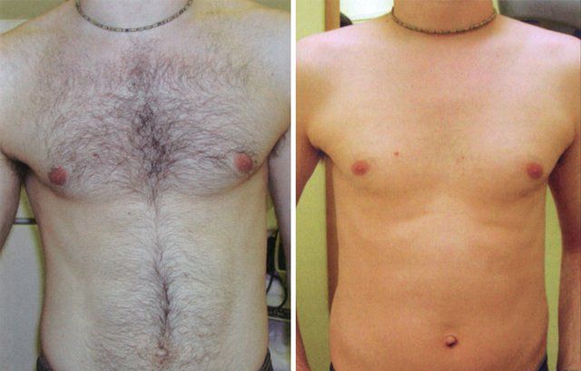An epilation client in Auckland