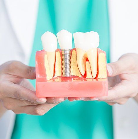 Dental Implant Illustration — Pinole, CA — Dalia E. Perez-Salinas, D.D.S. Dental Implant Illustration — Pinole, CA — Dalia E. Perez-Salinas, D.D.S.