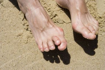 Hammertoe  Treatments—in Salem, OR