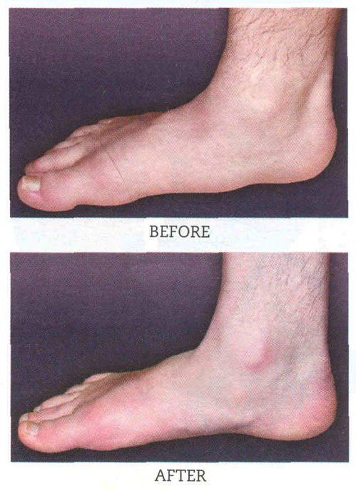 Side-by-side comparison of a foot. Before image shows a flat foot, after image shows a foot with an arch.