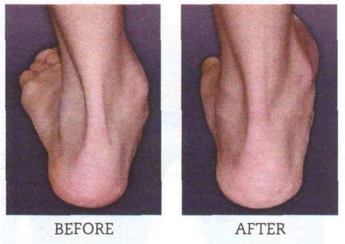 Foot with severe deformity before and after surgical correction.