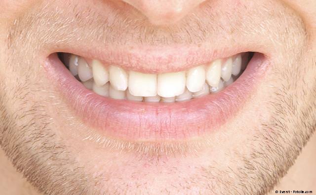 Derselbe Zahn wie oben mit einer unsichtbaren Komposit-Füllung