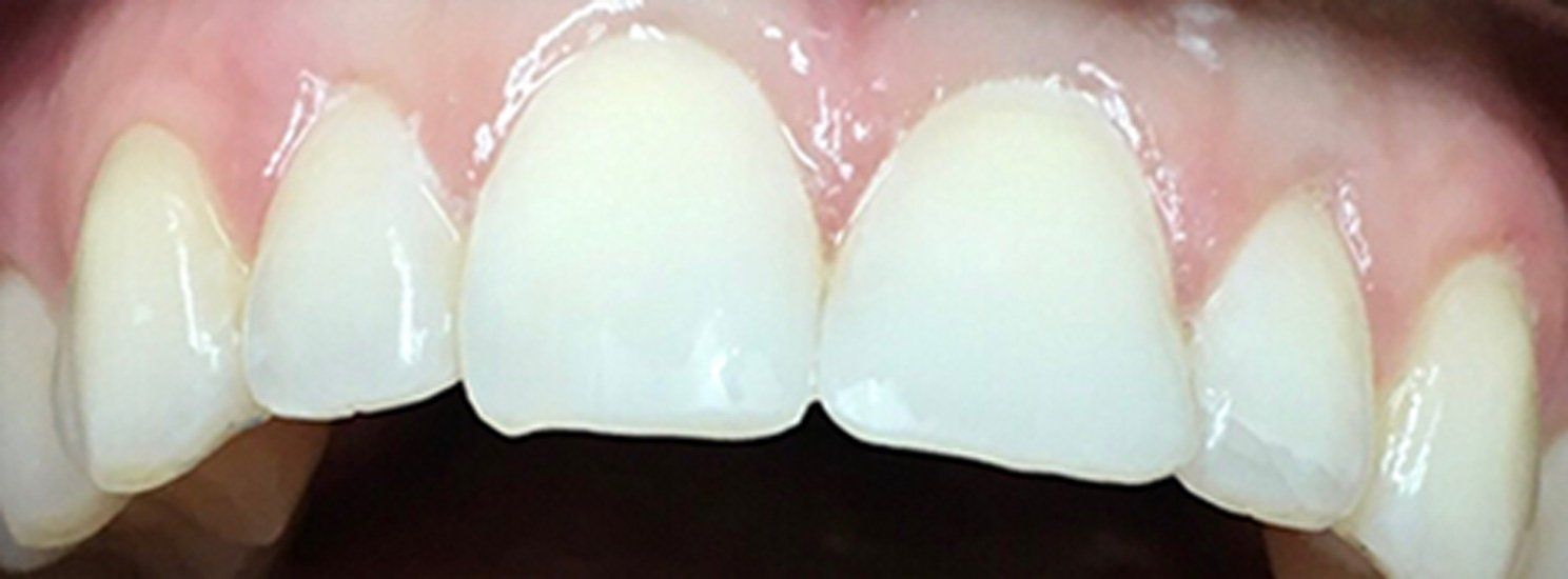 After Restorations