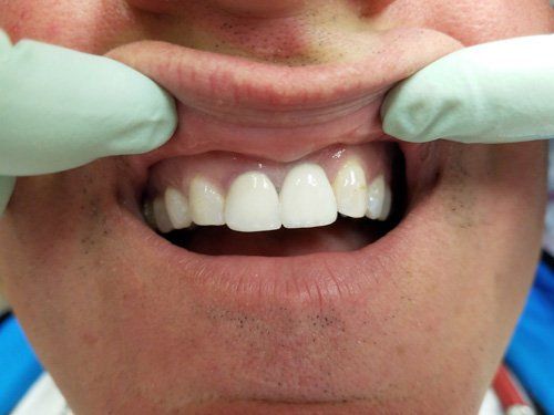 After Front Tooth Implant