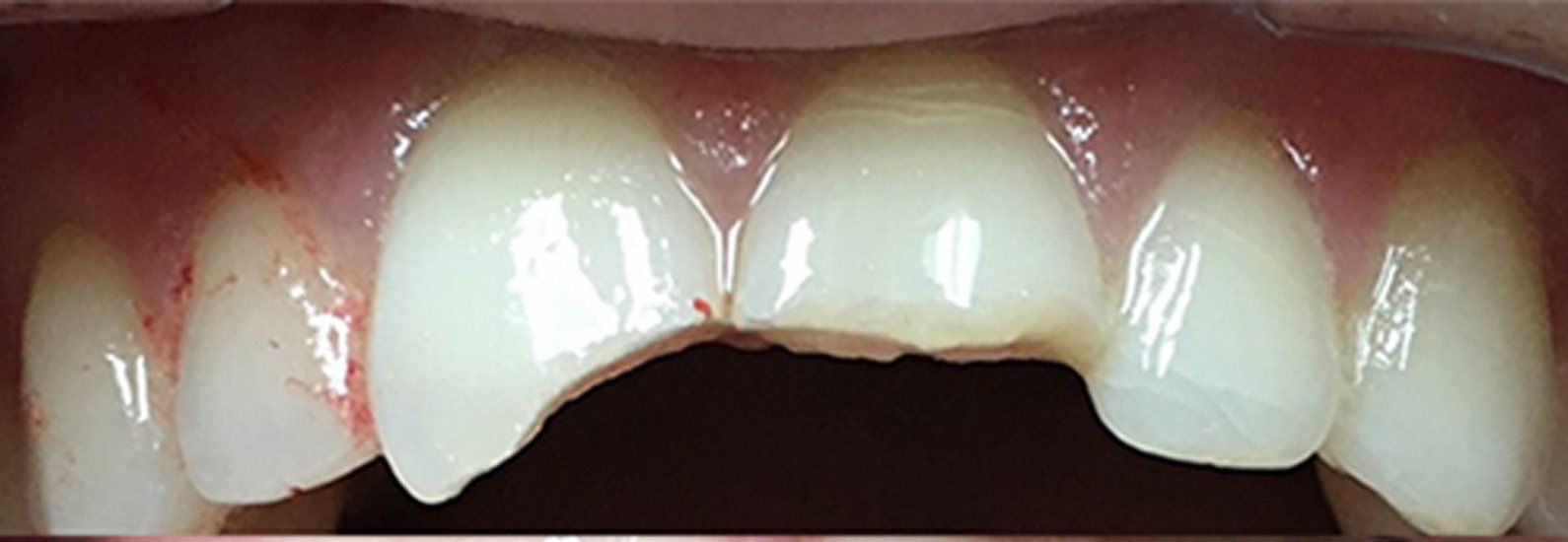 Before Restorations