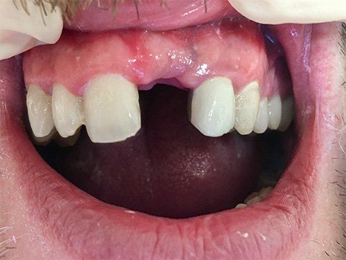 Anterior Bridge