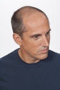 Before Gradual Hair Replacement in Latham, NY Before Gradual Hair Replacement in Latham, NY