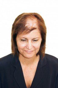 Before Integration & Augmentation Hair replacement in Latham, NY Before Integration & Augmentation Hair replacement in Latham, NY