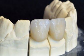 Dental Crown - Cosmetic Dentists in Terre Haute, IN