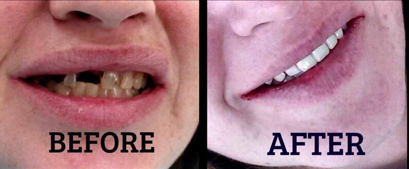 Denture Treatment — Dentistry in Terre Haute, IN