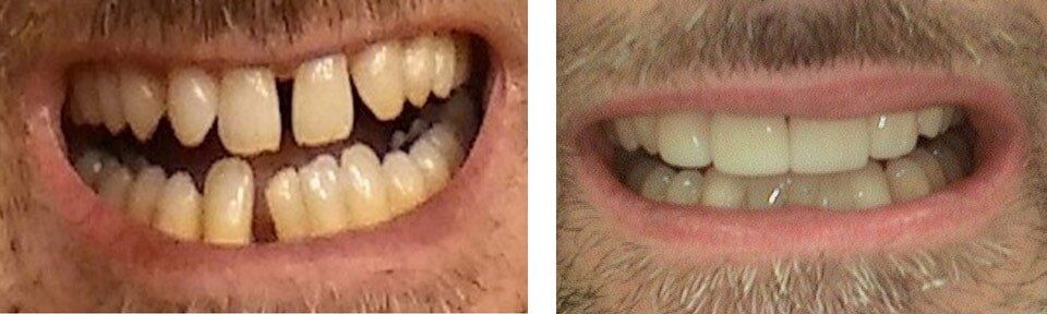 Diastema treatment — Dentistry in Terre Haute, IN