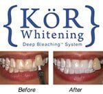 Teeth Cosmetic Example Result - Cosmetic Dentists in Terre Haute, IN Teeth Cosmetic Example Result - Cosmetic Dentists in Terre Haute, IN