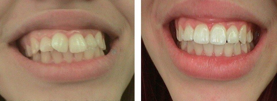 Uneven Teeth Before and After Correction - Orthodontics in Terre Haute, IN