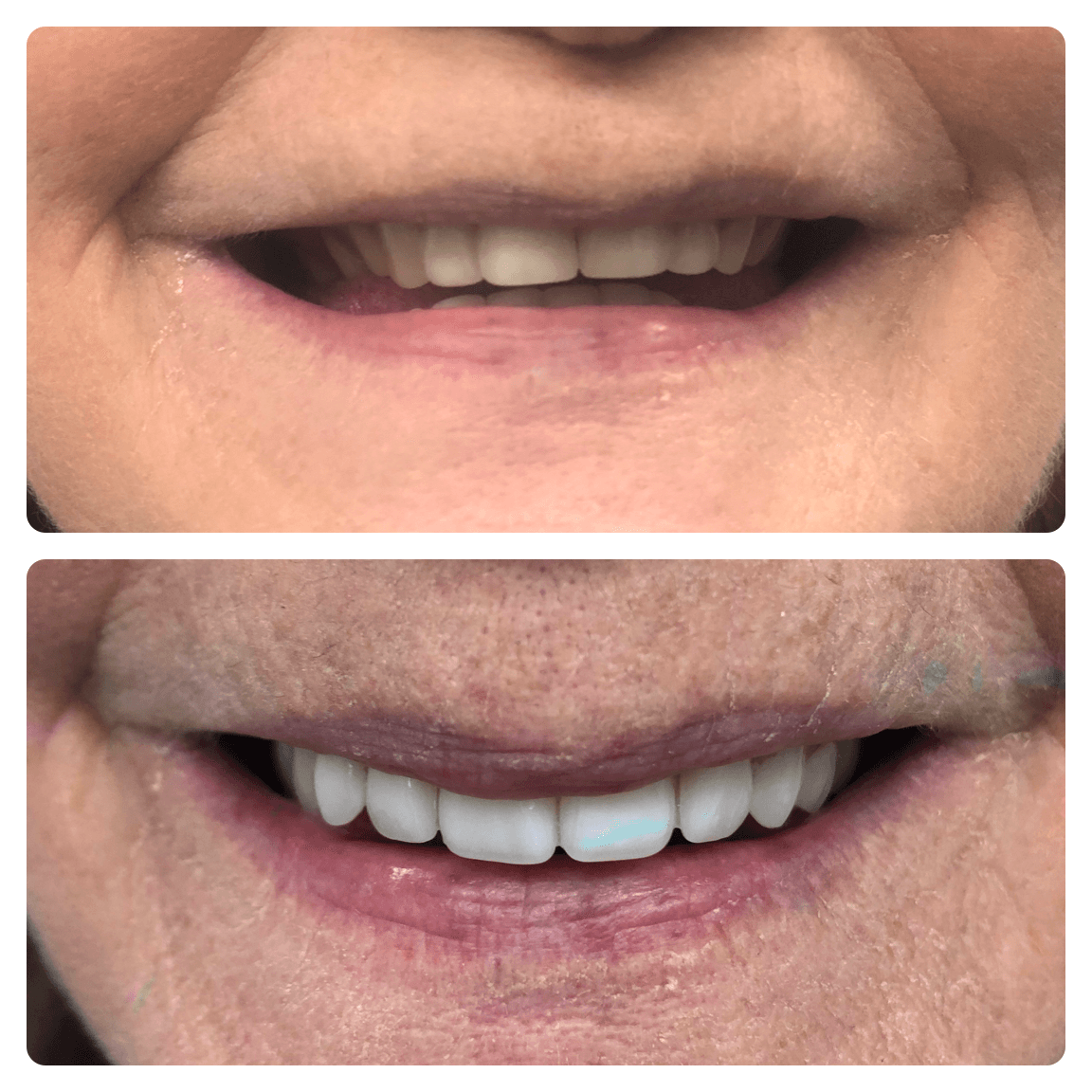 Comparison of two smiles: Top shows worn teeth, bottom shows bright, improved teeth.