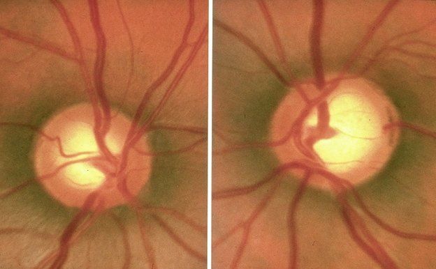 Glaucoma