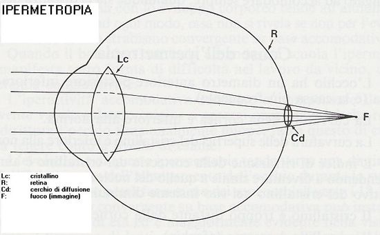 Ipermetropia