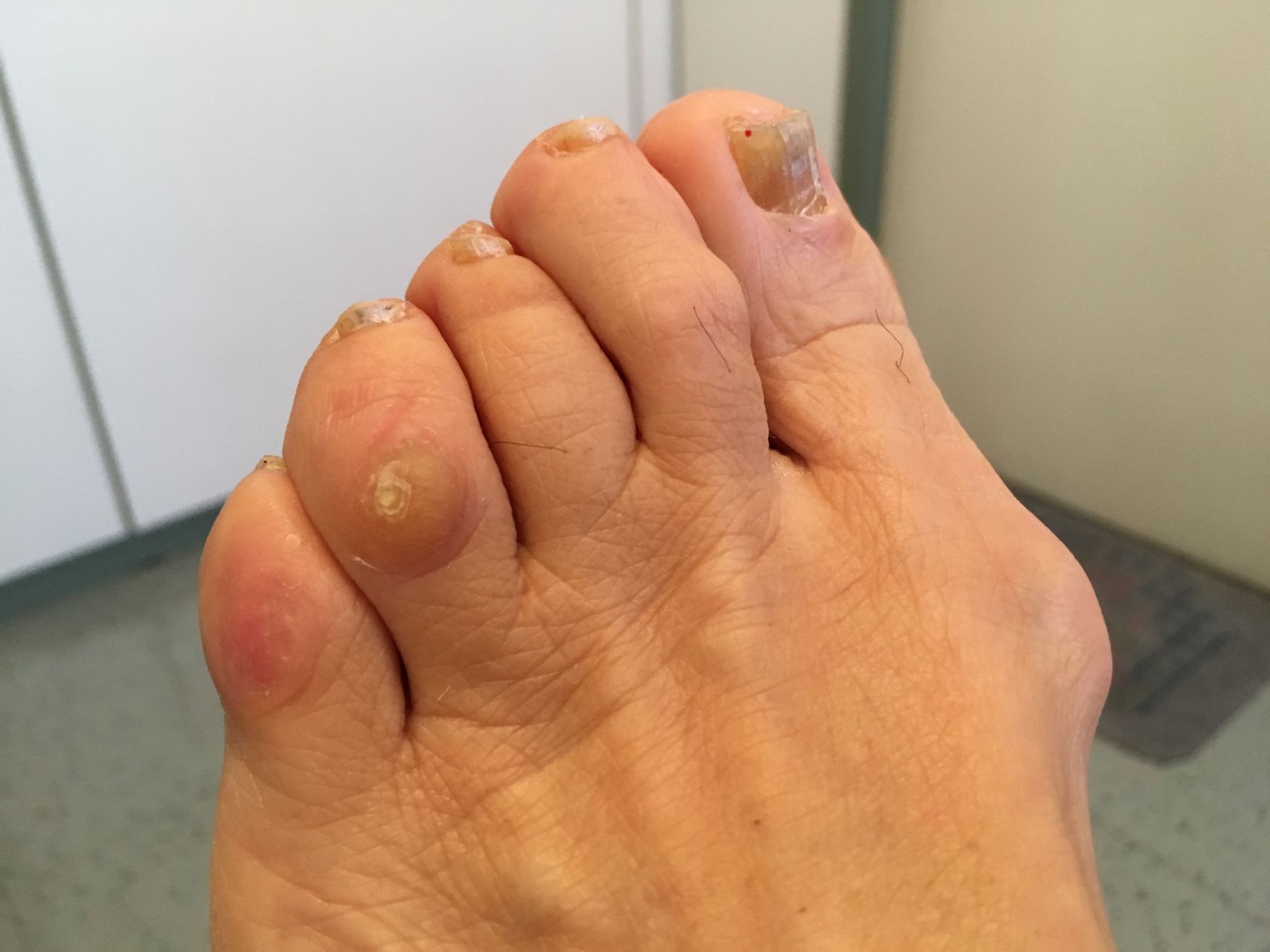 piede con patologie