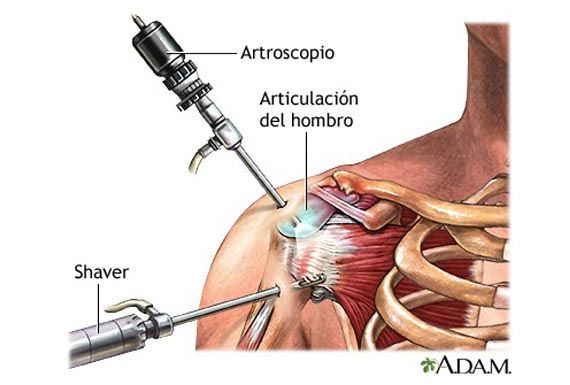 Inestabilidad Glenohumeral