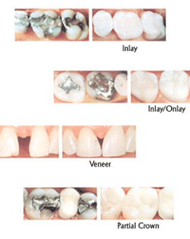 Inlay/Onlay, Venner & Partial Crown — Cosmetic dentistry in Katy, TX Inlay/Onlay, Venner & Partial Crown — Cosmetic dentistry in Katy, TX