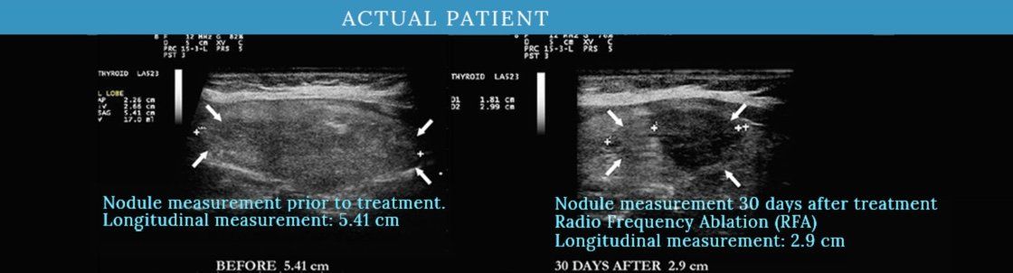 Radiofrequency Ablation Ultrasound