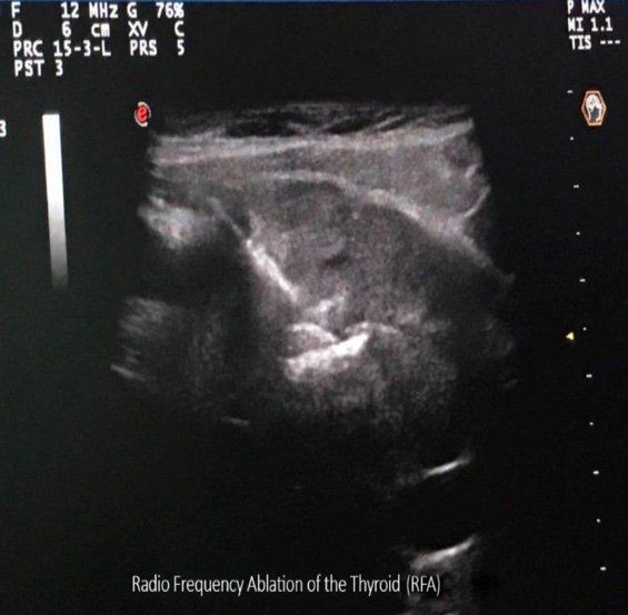 Radiofrequency Ablation - Ultrasound Photo