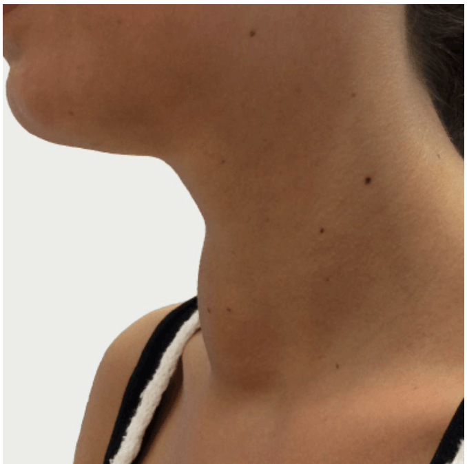 Radiofrequency Ablation Procedure - Before Photo