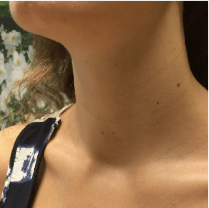 Radiofrequency Ablation Procedure - After Photo