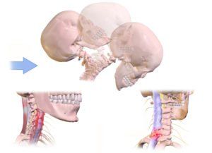 whiplash-injuries-symptoms