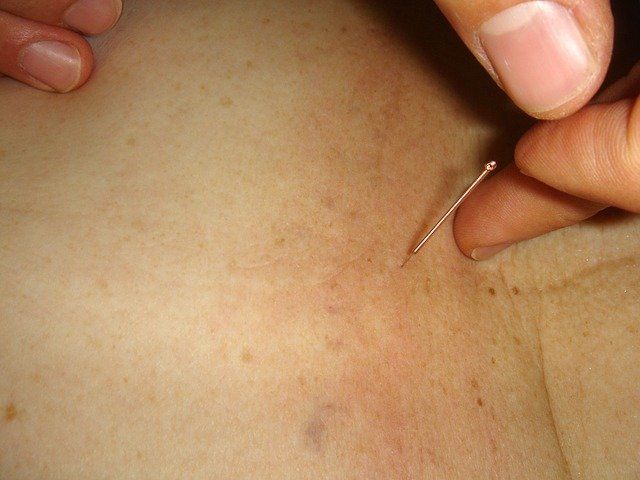 acupuncture-therapy
