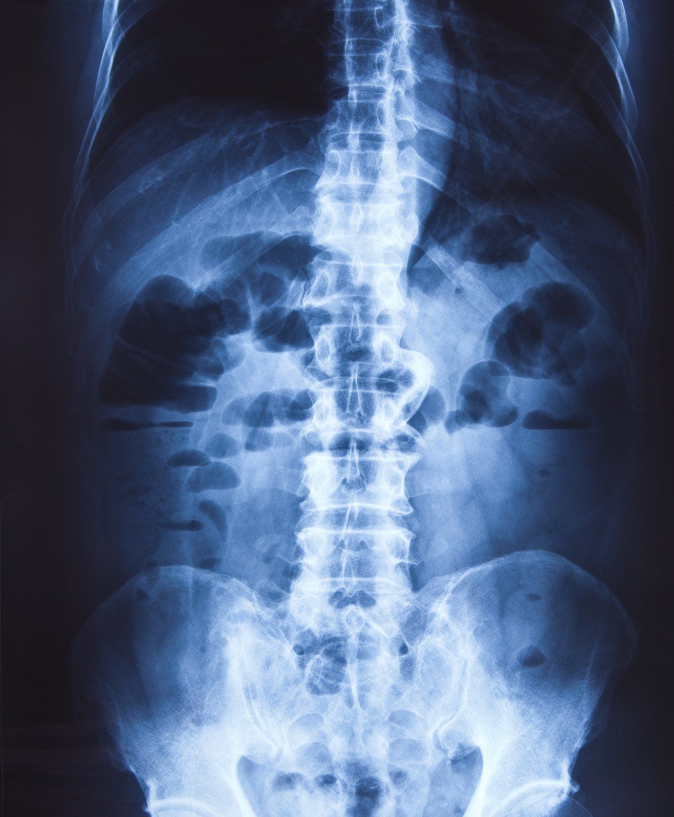 spinal-cord-stenosis-back-injury