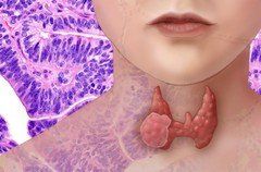 thyroid-problems-treatment