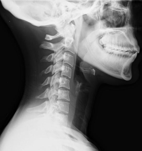 whiplash-neck-injuries