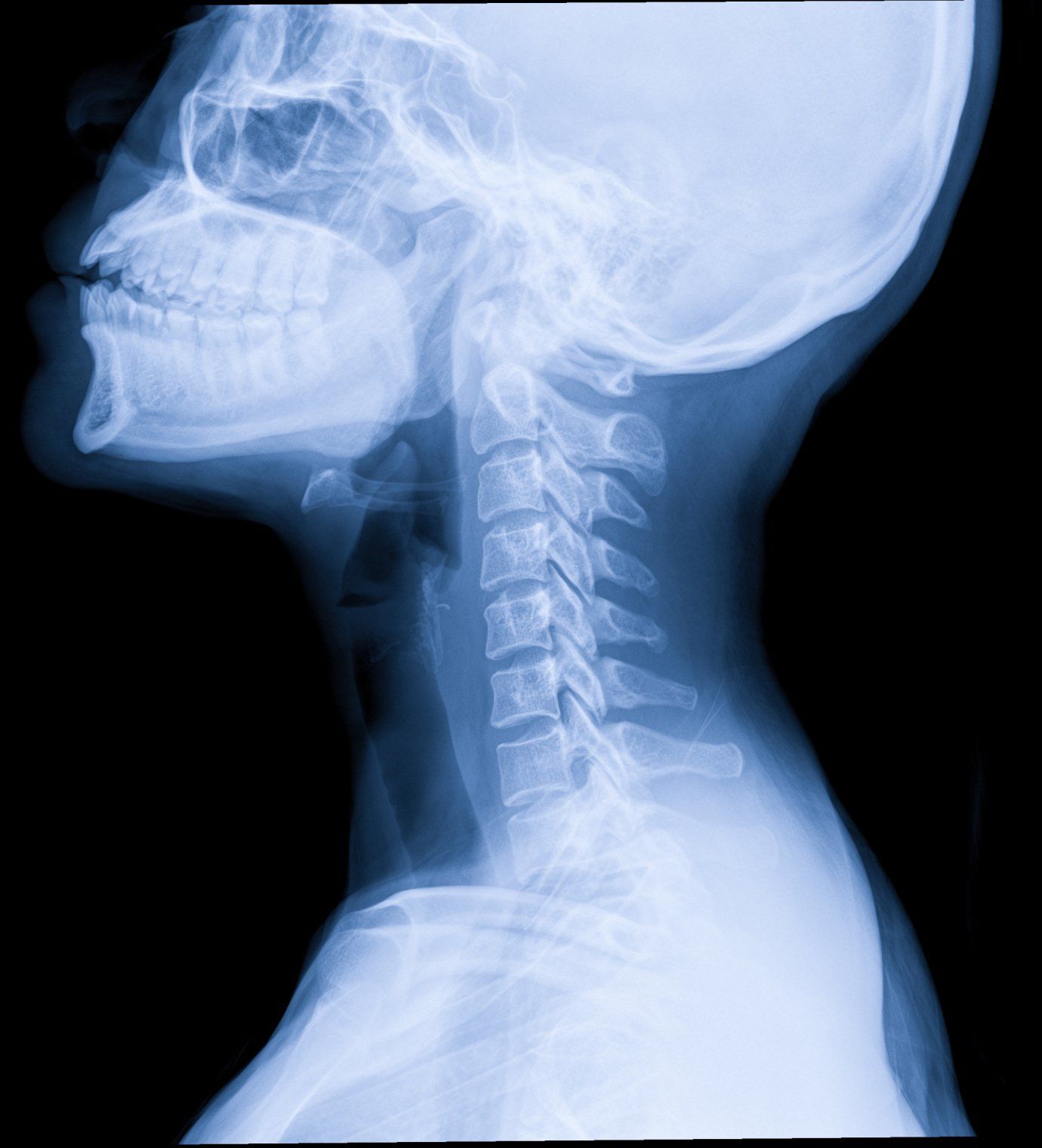 whiplash-neck-injury-xray