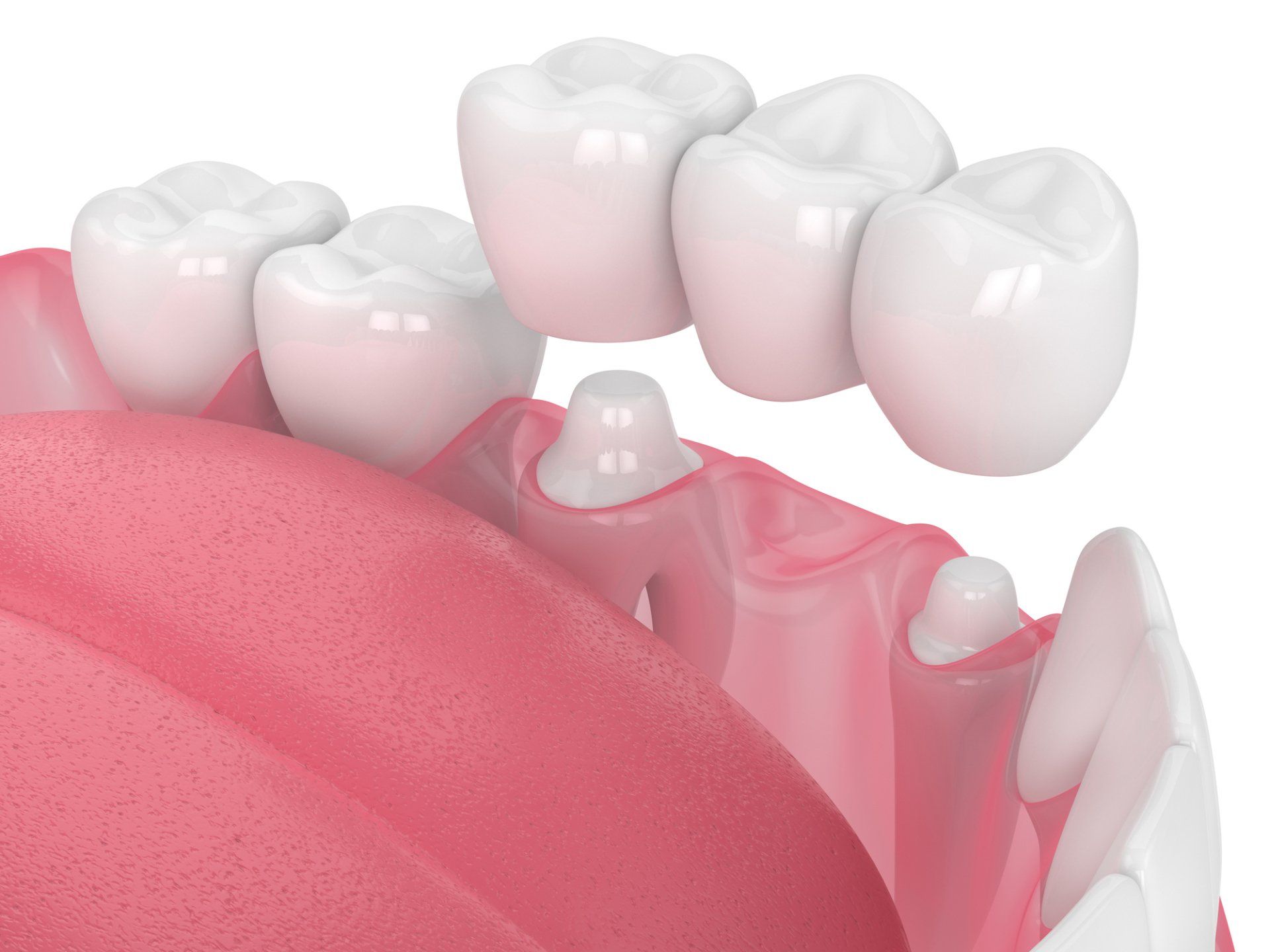 Crowns and Bridges — Eastpointe, MI — Eastland & Professional Dental Center
